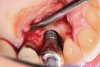 Fig 6. Palatal view following implantoplasty demonstrating reduction of the threads and surface modification.