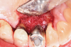 Fig 7. A graft consisting of demineralized freeze-dried fibers and cryopreserved mineralized bone with stem cells was placed at the site after wiping the surface with citric acid and sterile saline rinse. The graft was then layered with an amnion-chorion membrane prior to flap closure.