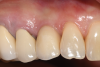 Fig 8. Clinical buccal view at 1-year postoperative. Probing depths were now 3 mm with no bleeding.