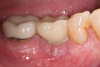 Fig 10. Clinical presentation demonstrating purulent exudate from the dental implant along with inflammation of the gingival tissue.