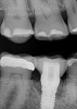 Fig 11. Pretreatment radiograph demonstrating bone loss on the mandibular right first molar.