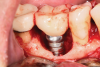 Fig 12. The lesion was visualized upon flap reflection. A three- to two-wall lesion on the mesial wrapped to the lingual, while the distal had a two-wall lesion that also extended to the lingual as a moat.