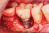 Fig 13. Implantoplasty was completed. Some bleeding at the distal obscured one thread that was impossible to plasty. The surface was subsequently wiped with citric acid prior to grafting.