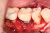 Fig 14. A graft consisting of demineralized freeze-dried fibers and cryopreserved mineralized bone with stem cells was placed at the site. The graft was layered with an amnion-chorion membrane prior to flap closure.