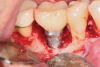 Fig 16. The site was exposed for placement of an acellular dermal graft to improve the phenotype. Note the hard-tissue fill at the mesial portion of the lesion, which extended to the lingual. One thread next to the bone at the distal was reduced with implantoplasty.