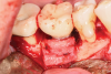 Fig 17. Acellular dermis was secured with 5-0 chromic gut suture.