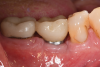 Fig 18. Buccal view at 15 months postoperative. Health was restored to the site with mostly 4 mm probing depths and absence of bleeding. Some interproximal and facial recession of the gingiva had occurred.