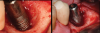 Fig 19. Comparison of a dental implant before (left) and after (right) implantoplasty. Being able to remove the crown and place a healing abutment allowed improved access to achieve a machine-like surface to the base of the peri-implantitis defect.