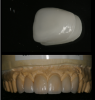 Fig 3. Veneers are typically made of feldspathic porcelain or lithium disilicate, and therefore tend to be highly translucent.