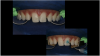 Fig 5. After etching, a universal bonding agent is applied to the veneers.