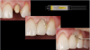 Fig 8. Cementation using a dual-cure, fluoride-releasing, self-adhesive resin.