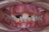 Fig 2. Initial situation of case involving an impacted maxillary right central incisor, frontal view (Fig 2) and occlusal view (Fig 3).