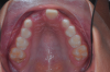 Fig 3. Initial situation of case involving an impacted maxillary right central incisor, frontal view (Fig 2) and occlusal view (Fig 3).