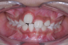 Fig 5. After performing an apical positioned flap, exposure of the impacted right central incisor was performed, frontal view (Fig 5) and occlusal view (Fig 6).