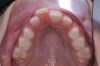 Fig 6. After performing an apical positioned flap, exposure of the impacted right central incisor was performed, frontal view (Fig 5) and occlusal view (Fig 6).