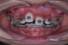 Fig 7. Clinical situation after rapid palatal expansion and orthodontic traction, frontal view (Fig 7) and occlusal view (Fig 8).