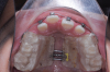 Fig 8. Clinical situation after rapid palatal expansion and orthodontic traction, frontal view (Fig 7) and occlusal view (Fig 8).