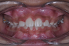 Fig 9. Clinical situation after completion of phase 1 treatment that allowed the impacted maxillary right central incisor to be properly positioned in the arch, frontal view (Fig 9) and occlusal view (Fig 10).