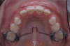 Fig 10. Clinical situation after completion of phase 1 treatment that allowed the impacted maxillary right central incisor to be properly positioned in the arch, frontal view (Fig 9) and occlusal view (Fig 10).