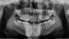 Fig 11. Panoramic x-ray taken after completion of phase 1 treatment. Note the position of the previously impacted maxillary right central incisor.