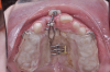 Fig 12. After expansion of the maxillary arch, the modified palatal expander was used for traction of the impacted maxillary right central incisor. Fig 12: Palatal expansion to gain space in the premaxilla for the impacted maxillary right central incisor. Fig 13: Traction of the impacted maxillary right central incisor through a palatal orthodontic attachment and the use of a power arm incorporated in the expander. Fig 14: Detailing the position of the impacted maxillary right central incisor with orthodontic fixed appliances.