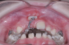 Fig 13. After expansion of the maxillary arch, the modified palatal expander was used for traction of the impacted maxillary right central incisor. Fig 12: Palatal expansion to gain space in the premaxilla for the impacted maxillary right central incisor. Fig 13: Traction of the impacted maxillary right central incisor through a palatal orthodontic attachment and the use of a power arm incorporated in the expander. Fig 14: Detailing the position of the impacted maxillary right central incisor with orthodontic fixed appliances.