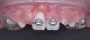 Fig 14. After expansion of the maxillary arch, the modified palatal expander was used for traction of the impacted maxillary right central incisor. Fig 12: Palatal expansion to gain space in the premaxilla for the impacted maxillary right central incisor. Fig 13: Traction of the impacted maxillary right central incisor through a palatal orthodontic attachment and the use of a power arm incorporated in the expander. Fig 14: Detailing the position of the impacted maxillary right central incisor with orthodontic fixed appliances.