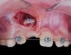 Fig 16. Example of the use of the closed-eruption technique to uncover an impacted maxillary right central incisor. Flap was raised to bond the orthodontic attachment.