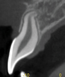 Fig 18. After traction, impacted maxillary central incisors often have roots with altered form and length. This periapical x-ray shows a short and dilacerated root of an impacted incisor that was brought into the arch.