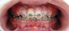 Fig 19. Gingival esthetic difference can be noticed in the impacted maxillary right central incisor as compared to the homologous tooth.