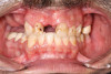 Fig 2. Initial presentation, intraoral view.