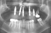 Fig 6. Postoperative panoramic radiograph on the day of surgery.