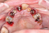 Fig 12. Partial extractions and placement of implants and multi-unit abutments.