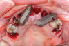 Fig 13. Initial scan of scan gauges with residual teeth retained for reference.