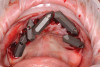 Fig 14. All implants, multi-unit abutments, and scan gauges in place.