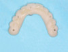 Fig 17. Maxillary provisional prosthesis with screw-access holes in prosthetically correct locations.