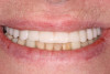 Fig 19. The patient’s smile display, the same day as surgery.