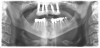 Fig 21. Postoperative panoramic radiograph on the day of surgery.