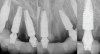 Fig 22. Postoperative periapical x-rays on the day of surgery demonstrating the provisional restoration with ti-bases fully seated to multi-unit abutments and ideal immediate implant placement.