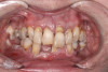 Fig 25. Initial clinical presentation, intraoral view.