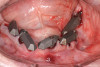 Fig 30. All mandibular scan gauges in place.