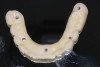 Fig 31. Mandibular provisional prosthesis printed demonstrating screw-access holes in prosthetically correct positions.