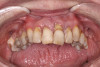 Fig 32. Maxillary arch at initial clinical presentation.