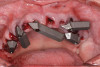 Fig 35. All scan gauges in place in maxillary arch.