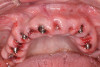 Fig 36. Flapless immediate implant maxillary surgery; 5-hour postoperative, prior to insertion of maxillary provisional restoration.
