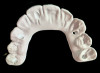 Fig 37. Display of prosthetically correct screw-access channels in maxillary provisional prosthesis.
