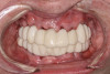 Fig 38. Maxillary and mandibular provisional restorations inserted, day of surgery.