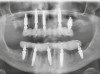 Fig 40. Postoperative panoramic radiograph on the day of surgery.