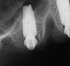 Fig 41. Postoperative periapical x-rays on the day of surgery demonstrating ideal immediate implant placement in bone.
