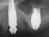 Fig 42. Postoperative periapical x-rays on the day of surgery demonstrating ideal immediate implant placement in bone.